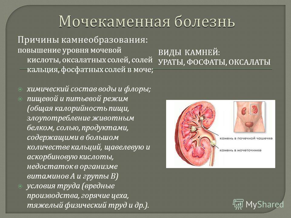 отсутствие семяизвержения при мочекаменной болезни