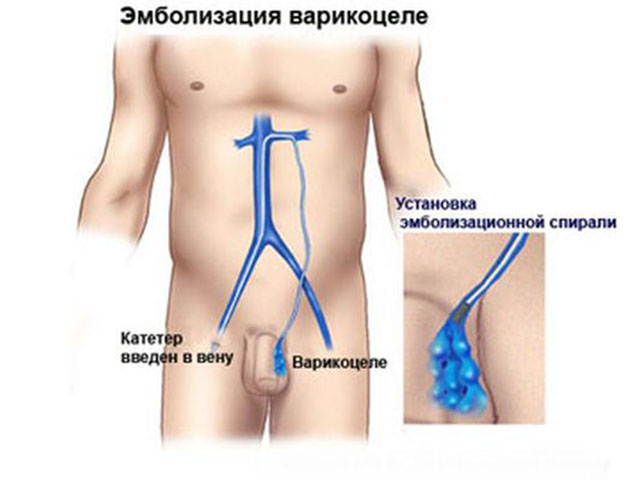 Варикозное Расширение Вен В Паху