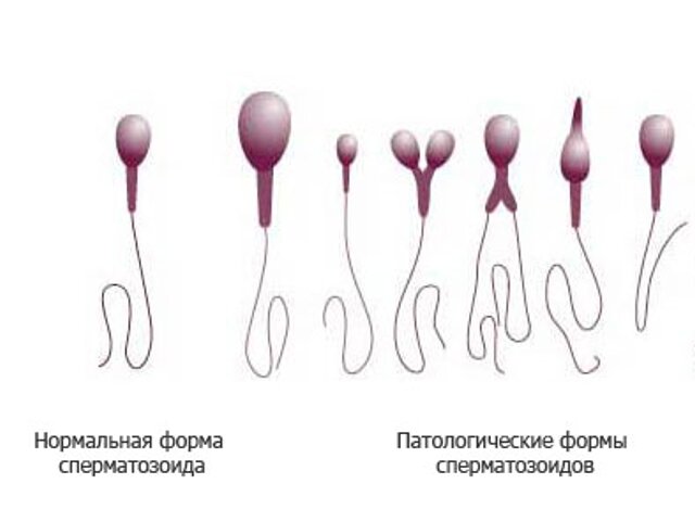 уродства сперматозоидов