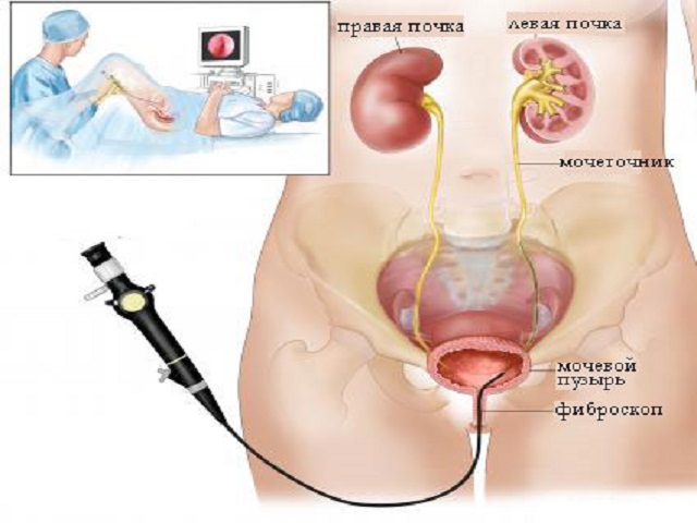 Цистоскопия мочевого пузыря у мужчин, подготовка детей: фото и видео
