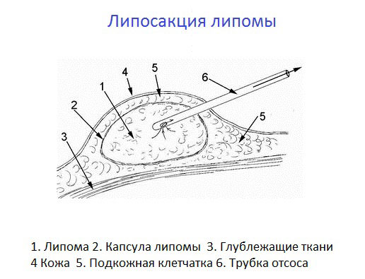 Жировик на мошонке фото