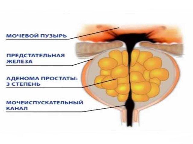 Тур урология. Аденома предстательной железы. Доброкачественная гиперплазия предстательной железы. Аденома предстательной железы операция.