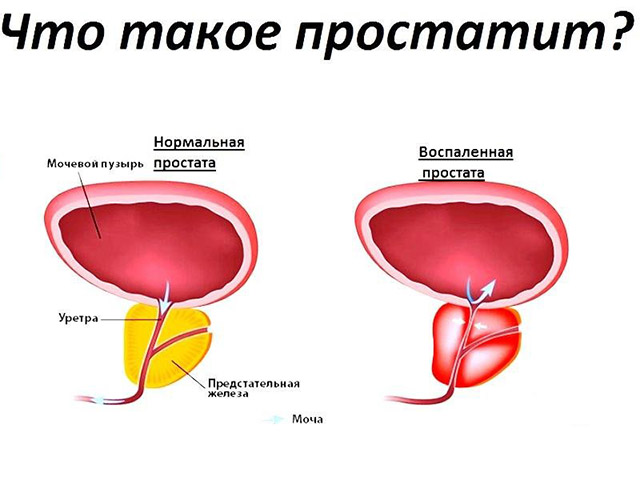 Картинка мочевого пузыря у мужчин