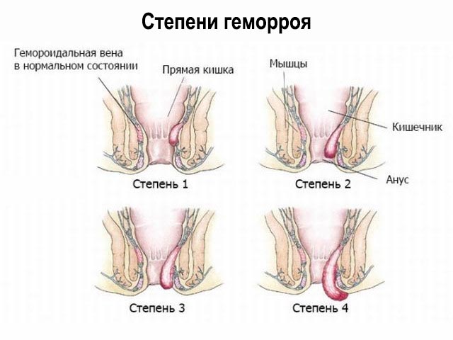 Схема различных стадий 