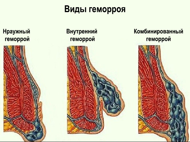 Тромбофлебит заднего прохода. Тромбированный внешний узел геморрой. Перианальный геморрой. Внешний наружный геморрой.