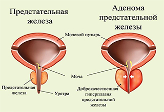 Препараты при гиперплазии предстательной железы